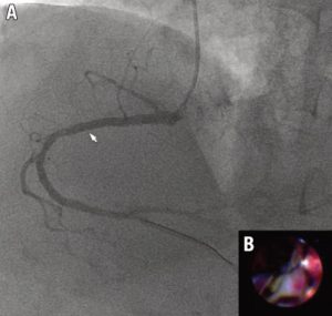 Angiographic and angioscopic findings after coronary intervention