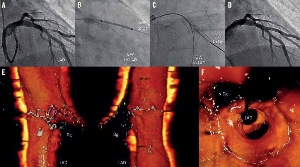 Side-branch-restenosis