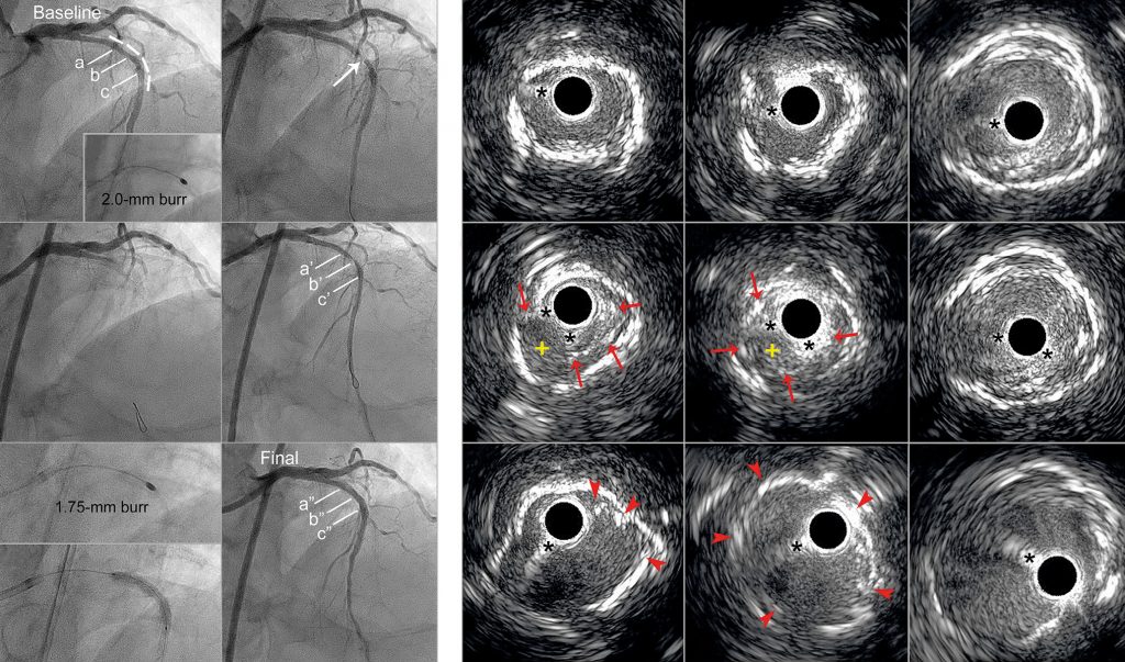 Acute coronary occlusion due to stent deformation caused by rotational atherectomy of an underexpanded, undilatable stent: an unusual complication and its bail-out