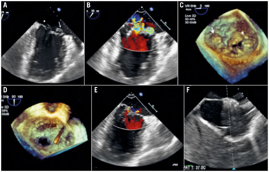 Figure 1. Transoesophageal echocardiography images during the MitraClip procedure.
