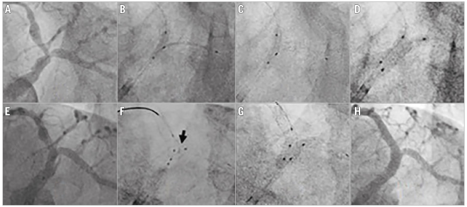 Figure 1. Angiography showing the steps of the nano-crush technique. A) Vessel anatomy showing bifurcation lesion in the distal LM and the ostio-proximal LAD and LCx. B) Side branch stent positioning with an inflated NC balloon in the main branch. C) Balloon crushing of the side branch stent. D) First kissing balloon inflation with the stent balloon and an NC balloon. E) Positioning of the main branch stent after removing the balloon and stent from the side branch. F) Positioning NC balloons in the main branch and side branch after re-crossing the side branch. Arrow shows minimally crushed stent at the carina. G) Final kissing balloon inflation. H) Final result.