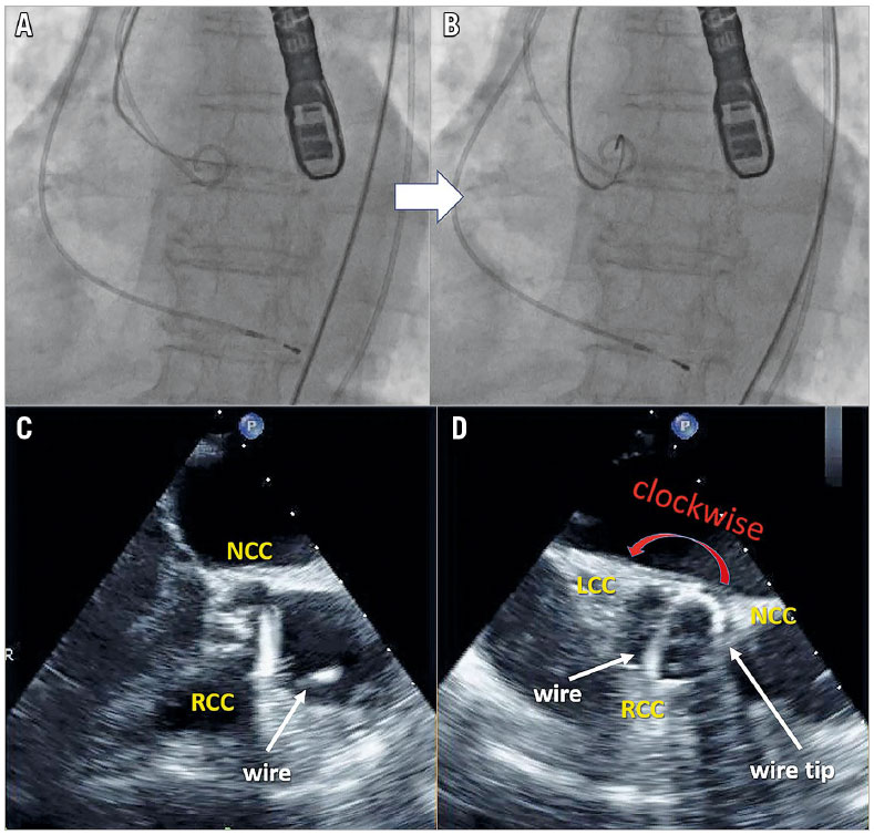 Figure - Transoesophageal echocardiography-guided wire technique for crossing a stenosed aortic valve during transcatheter aortic valve