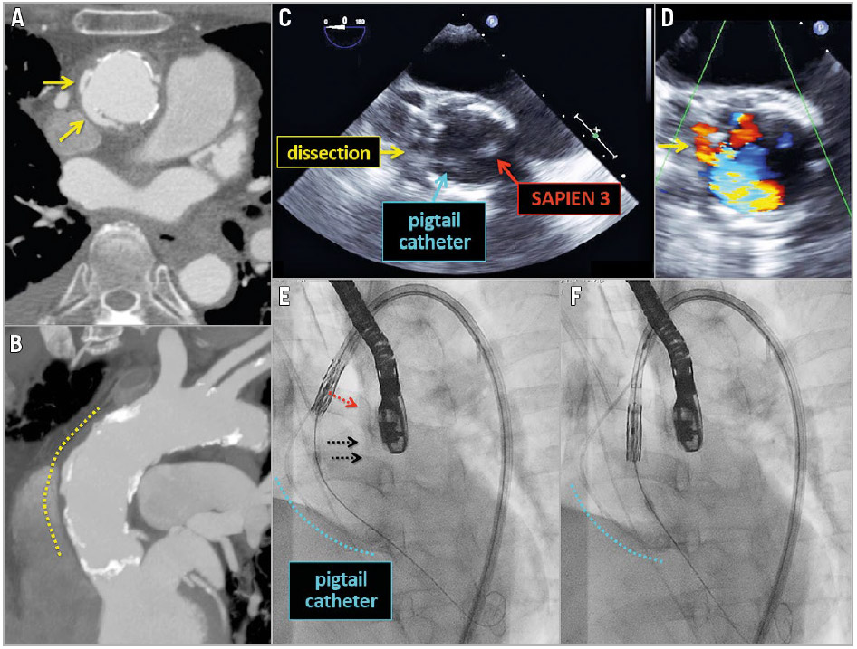 Figure - Transcatheter aortic valve replacement through chronic ascending aortic dissection