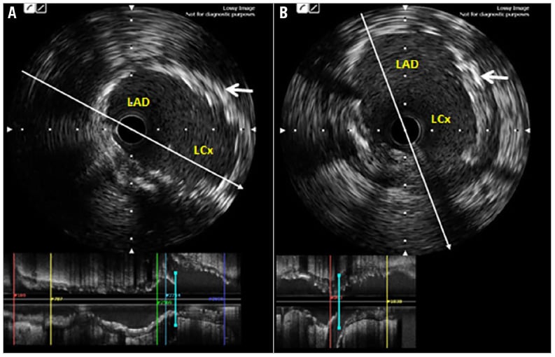Figure 3. IVUS images of a patient with LMCA bifurcation stenting using the nano-crush technique. A) LAD to LMCA pullback showing full coverage of the LCx ostium by the stent strut. B) LCx to LMCA pullback. White arrow indicates minimally crushed stent segment in panels A and B.