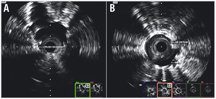 Figure 4. IVUS pullback. A) Main branch. B) Side branch to main branch.