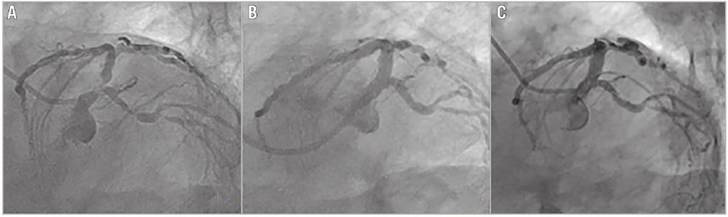 Figure 5. Coronary angiography of a patient showing significant bifurcation lesion at baseline (A), good coronary flow after stenting with the nano-crush technique (B), and stent patency at one-year follow-up (C).