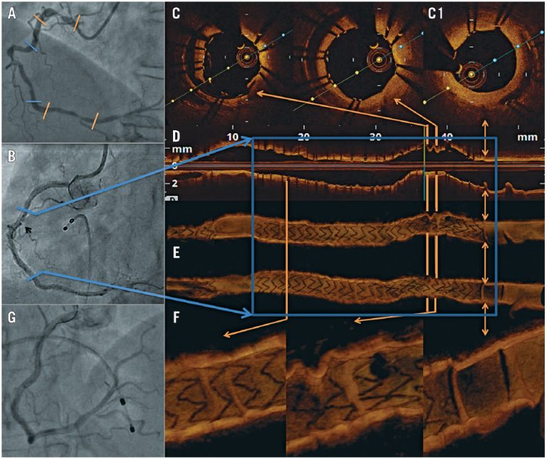 Concertina effect caused by stents insights from OCT AsiaIntervention