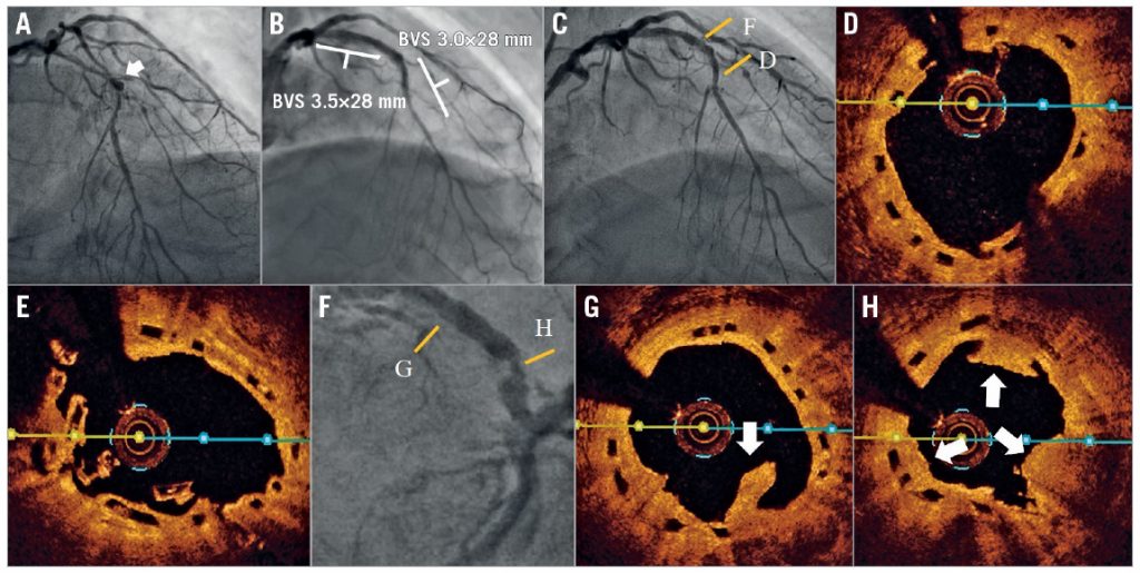 Drug-coated balloon treatment of late scaffold thrombosis and proliferated neointima and atherosclerotic plaque