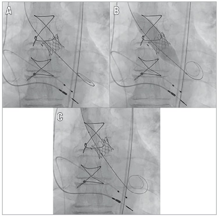 Figure 1. Fluoroscopic images of the stages of valve-in-valve (ViV) transcatheter aortic valve replacement (TAVR) followed by bioprosthetic valve fracture (BVF). A) Immediately after ViV TAVR. B) During BVF before fracture of the surgical ring. Note the waist of the balloon at the level of the surgical valve ring. C) Final fluoroscopic results.