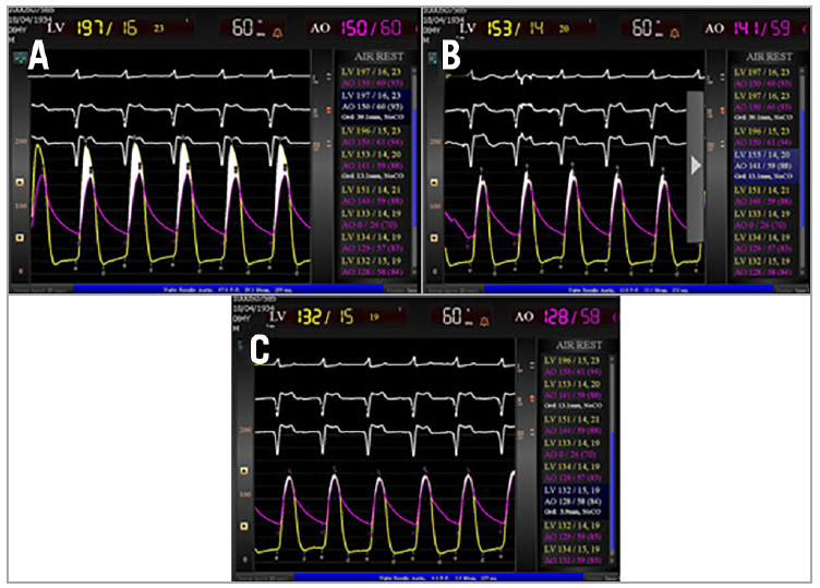 Figure 2. Example of procedural haemodynamics with ViV transcatheter aortic valve replacement and bioprosthetic valve fracture. A) Baseline (pre-ViV) haemodynamics demonstrating severe bioprosthetic aortic stenosis with a mean aortic valve gradient of 36 mmHg. B) Haemodynamics post ViV with SAPIEN 3 20 mm implantation revealed a mean gradient of 13 mmHg. C) Haemodynamics post BVF demonstrating a mean gradient of 3 mmHg.