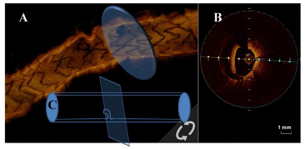 Supplementary Figure 1. Illustration for axial OCT having a dissection-like appearance (concertina effect).