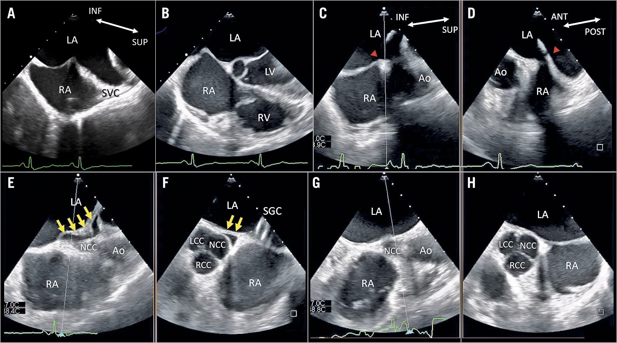 Pseudopericardial effusion due to excess tension caused by a guide catheter during the MitraClip procedure