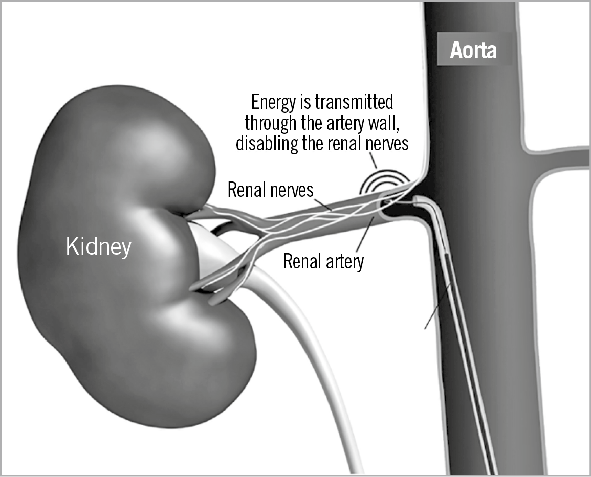 Figure 1. The concept of catheter-based renal denervation.