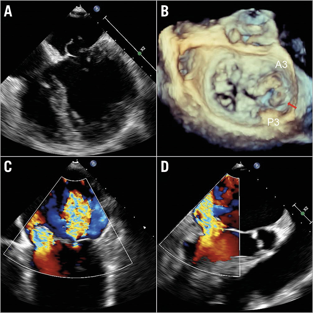 Figure 1. Bileaflet mitral valve prolapse with severe mitral regurgitation (MR). A, B) Transoesophageal echocardiogram (TOE) images of prolapsed segments A2/P2, A3/P3 with predominant prolapse of A3/P3 and a small ruptured chord at the tip of the posteromedial segment (red arrow). Severe MR in the apical 4-chamber (C) and the left ventricular outflow tract (LVOT) view (D).