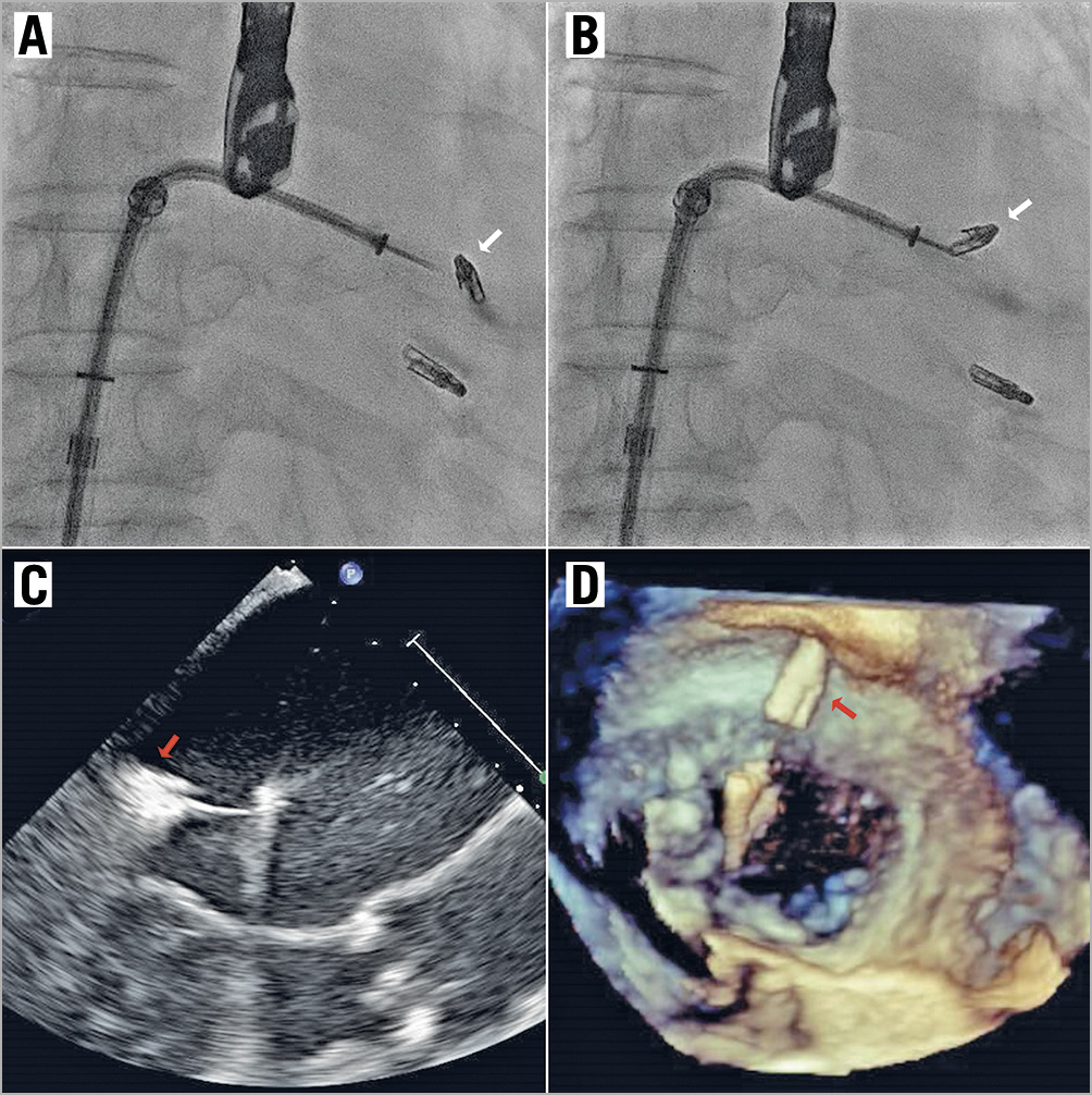 Figure 2. MitraClip embolisation. A, B) Fluoroscopic images showing complete detachment of the 2nd MitraClip (white arrows) after deployment but held within the left atrium by the gripper line. TOE images of the dislodged MitraClip (red arrows) in the LVOT view (C) and the en face 3D view where it is held above the mitral valve by the gripper line (D).