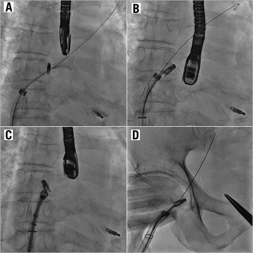 Figure 3. Snaring of embolised MitraClip. Fluoroscopic images showing (A) an unsuccessful attempt to snare the MitraClip with the EN Snare. B) The GooseNeck snare was successful in snaring the clip. The Clip was pulled across the interatrial septum (C) and to the common femoral vein (D).