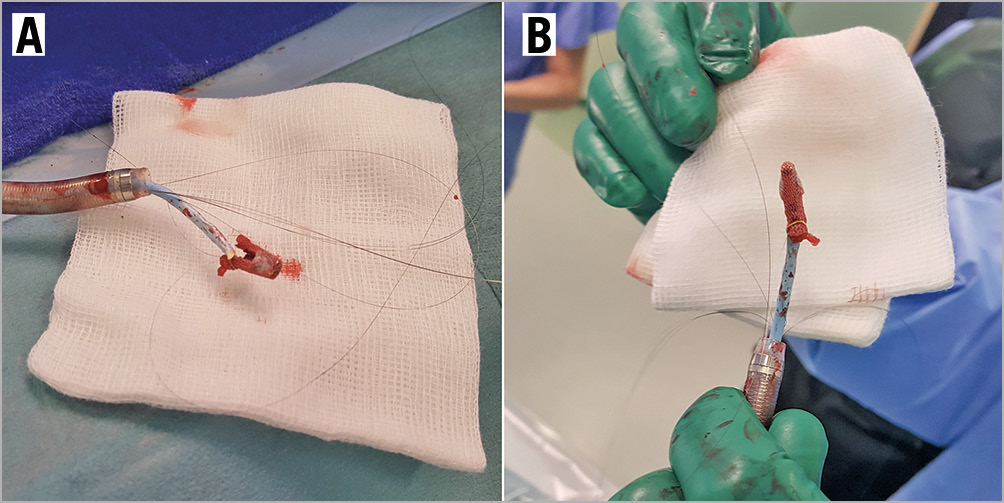 Figure 4. Embolised MitraClip removed. A, B) Photographic images of the MitraClip removed from the patient, with the GooseNeck snare still attached to one of the clip arms.