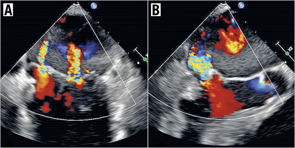 Figure 5. Residual MR. TOE images of residual moderate to severe MR in the intercommissural view (A) and the LVOT view (B), with just a single MitraClip deployed. There was no evidence of torn leaflets seen.