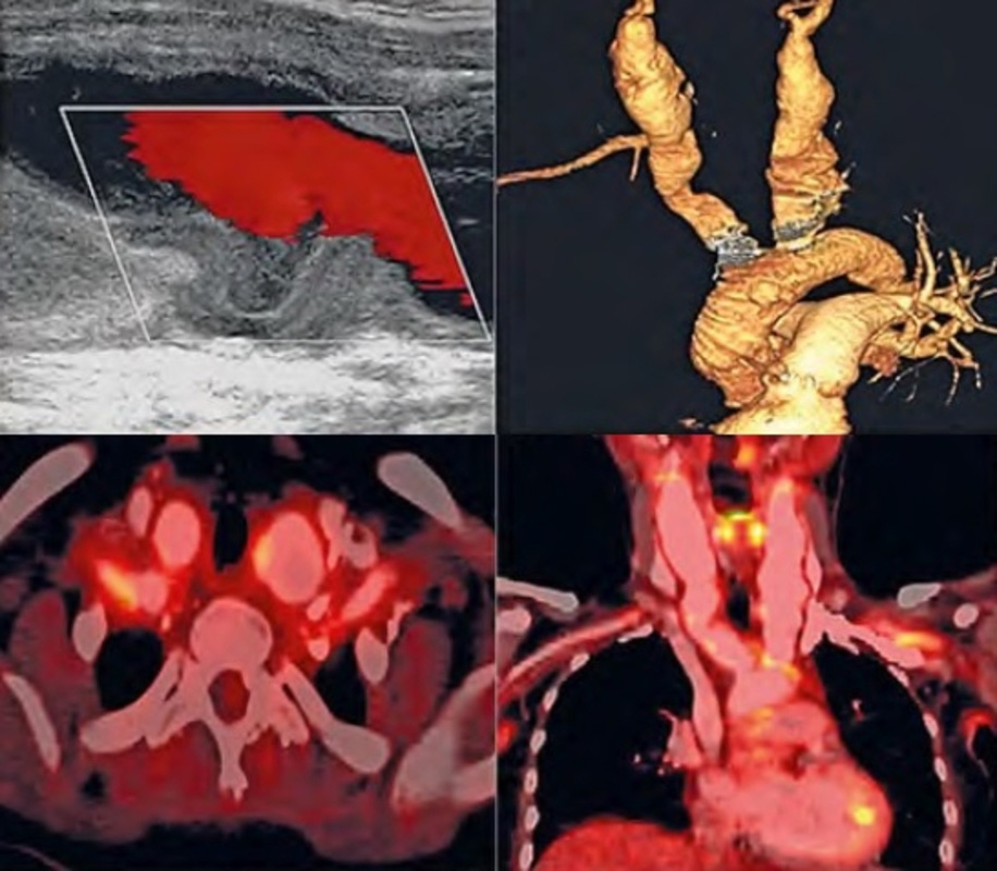 Management of acute MI in remote and resource-limited geographies, importance of complete revascularisation, critique on renal denervation therapy for hypertension treatment, registries on DES and TAVR from Asian countries, and more...