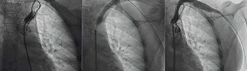 Bilateral pulsatile carotid aneurysm