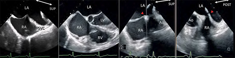 Pseudopericardial effusion due to excess tension caused by a guide catheter during the MitraClip procedure
