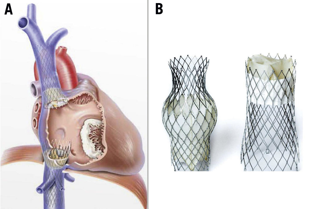 Novel Treatment Of Atrial Functional Tricuspid Regurgitation Using