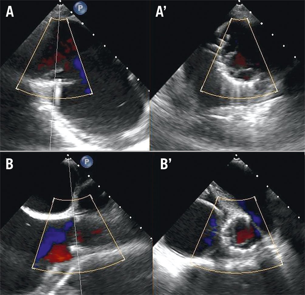 Novel Treatment Of Atrial Functional Tricuspid Regurgitation Using