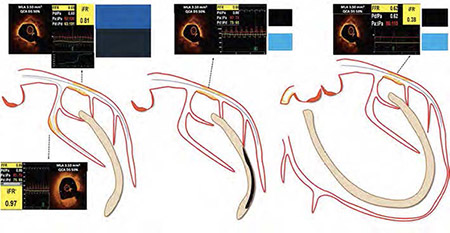 Expert Review : Coronary physiology in the catheterisation laboratory: an A to Z practical guide