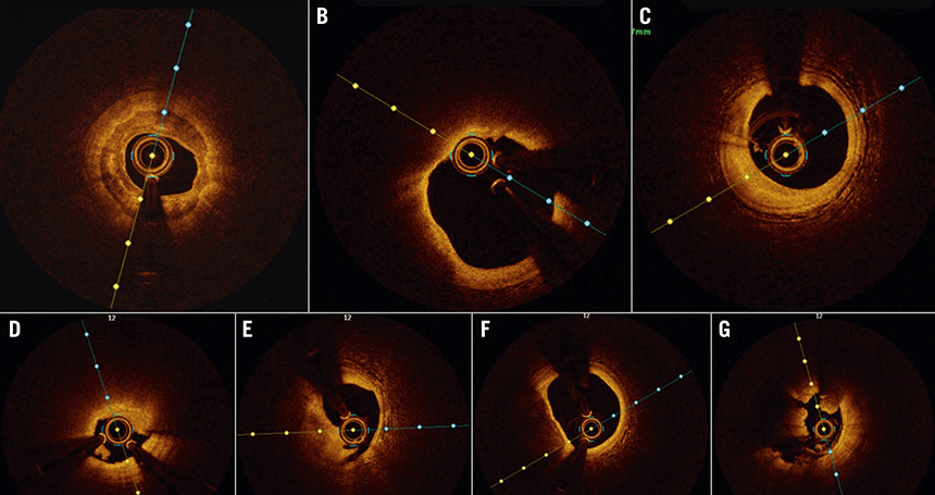 Expert review: OCT-guided PCI in Southeast Asia