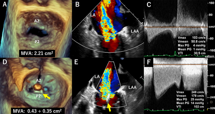 Flashlight: Paracentral MitraClip implantation with small valve area