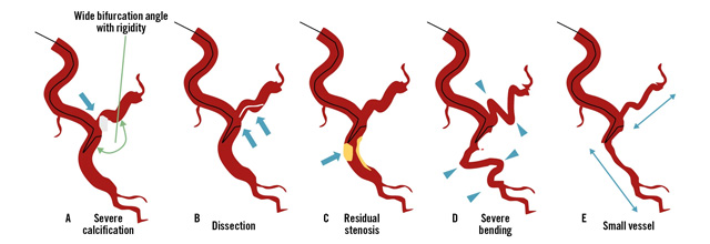 Original Research: Predictors of reverse wire technique failure