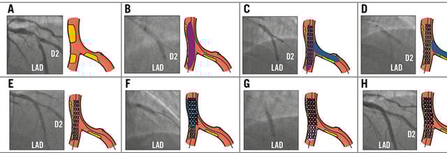 Flashlight: Jailed drug-coated balloon technique for bifurcations