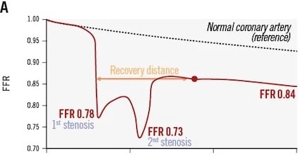 Original Research: CFD and tandem coronary lesion progression