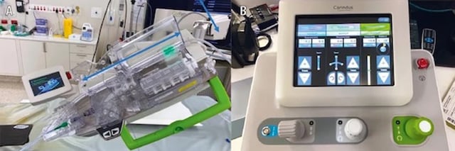 Original Research: The robotic PCI RCT