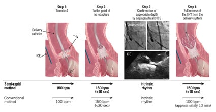 Original research: Semi-rapid deployment in Evolut FX TAVI